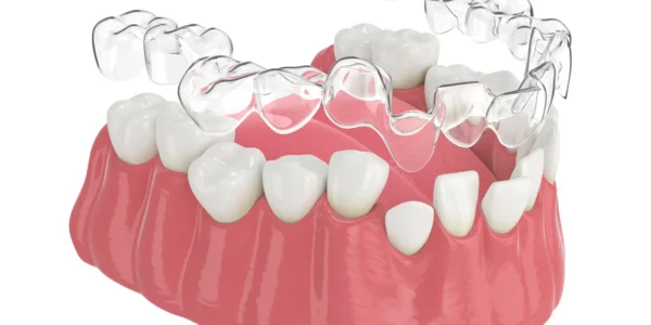 Jak stosuje się nakładki prostujące zęby