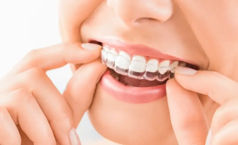 Invisalign warszawa cena